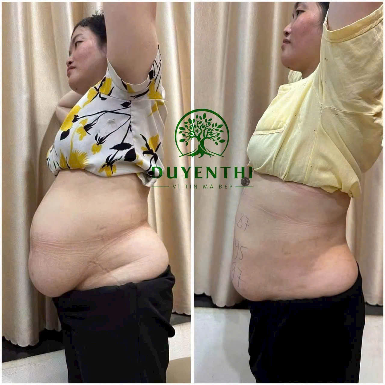 ấn huyệt giảm mỡ mỏ cày